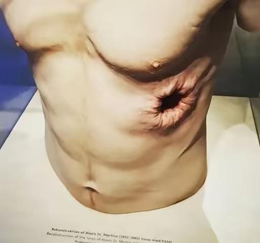 1822年6月，一位叫阿列克斯·圣马丁的加拿大船夫，在麦基诺岛卸货时，不小心被一