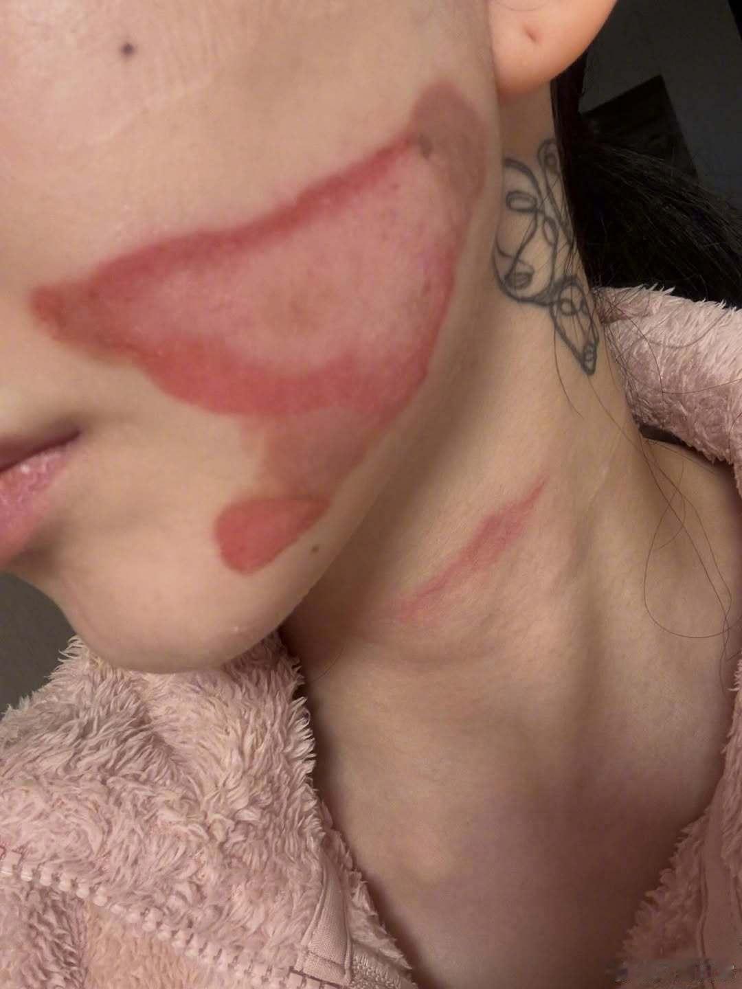 这看着好严重啊……权珉娥医美后毁容