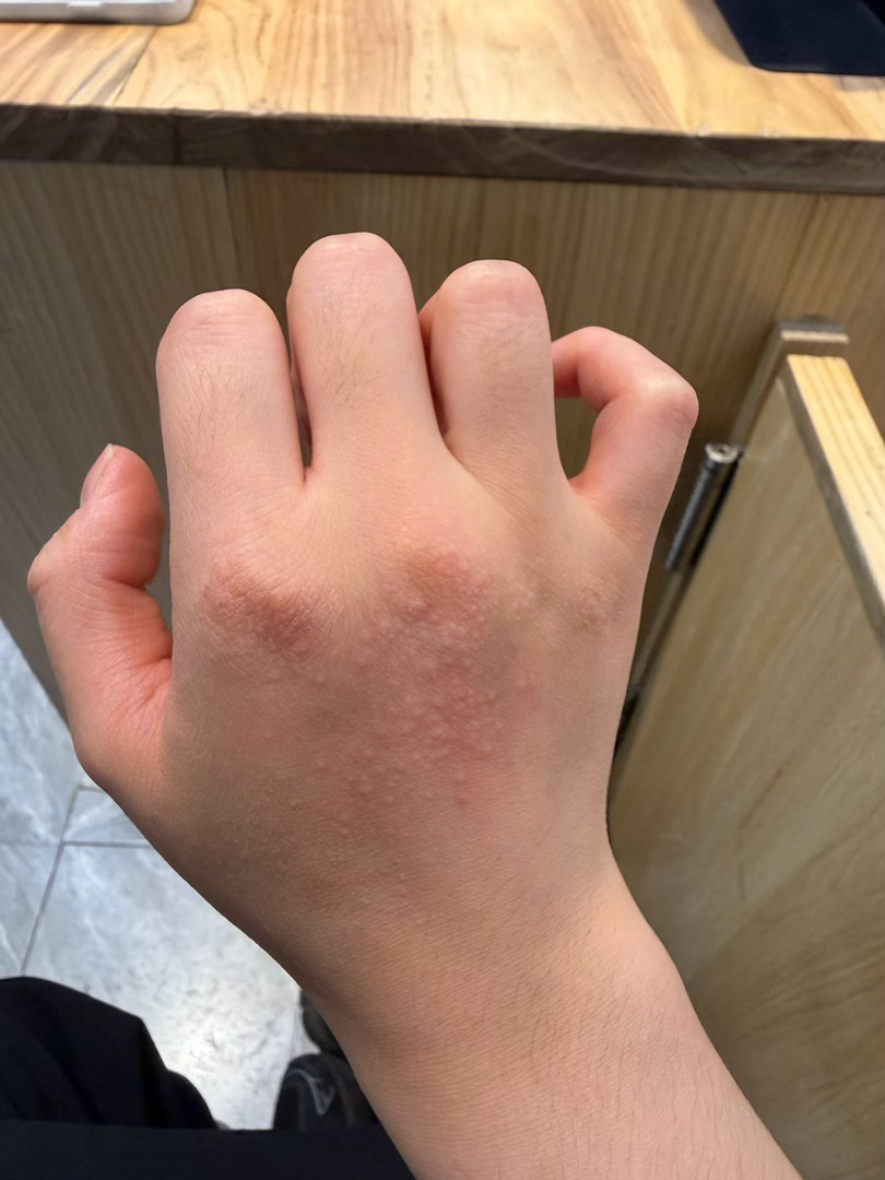 我真的求你了 寻麻疹还是神经系皮炎啊 对我好点吧