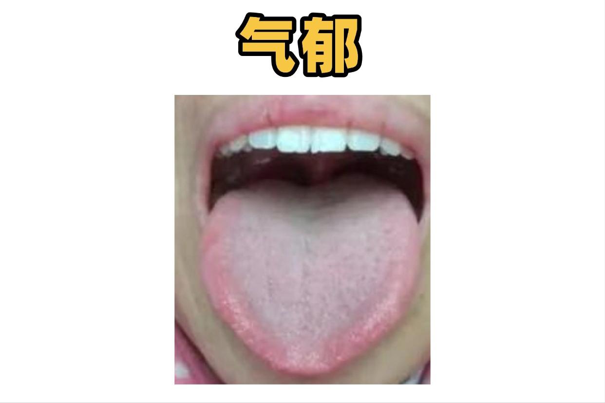 气郁、湿郁、痰郁、血郁，4 种郁滞舌象对照，教你对症调理不踩坑！

①气郁
典型