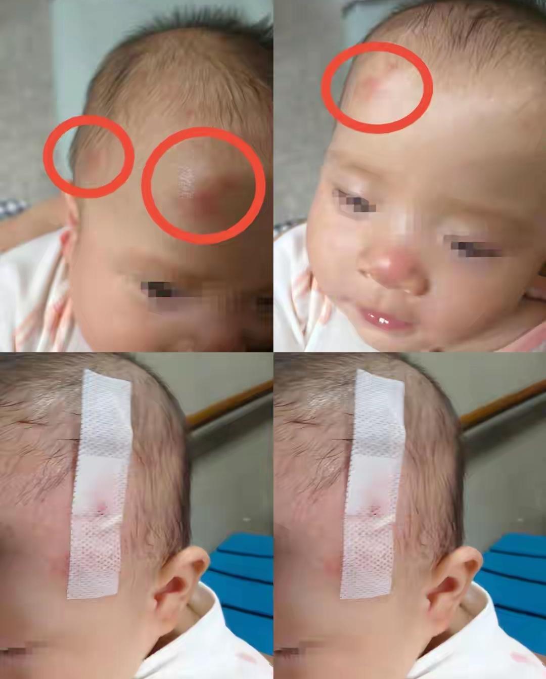 这个小宝宝就是云南被玩具车撞倒摔伤的宝宝，当时才5个月大被妈妈抱在怀里，没想到在