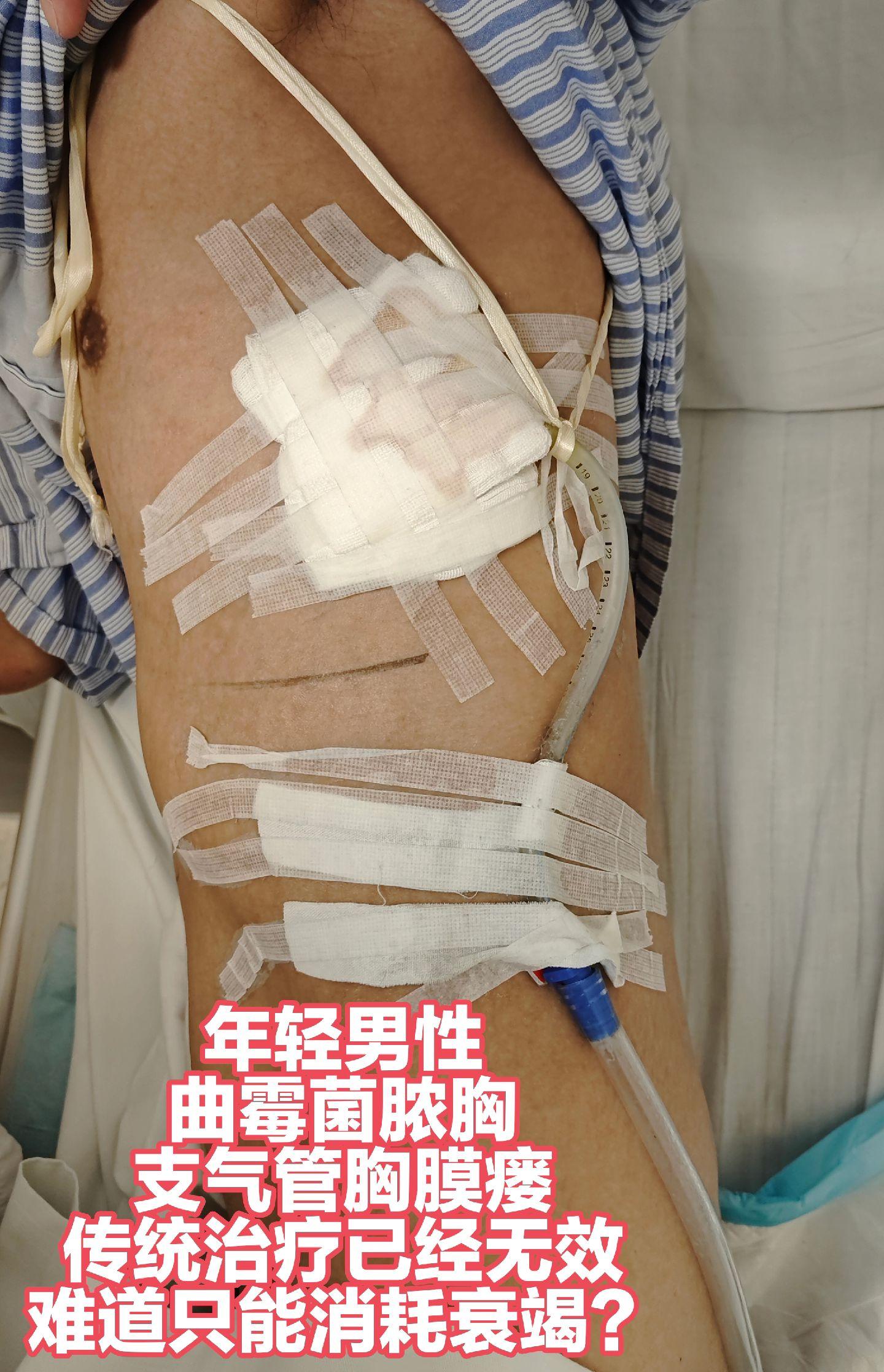 白发妈妈推着儿子，曲霉菌脓胸BPF，传统观念中已无法治疗，来七院微创修...
