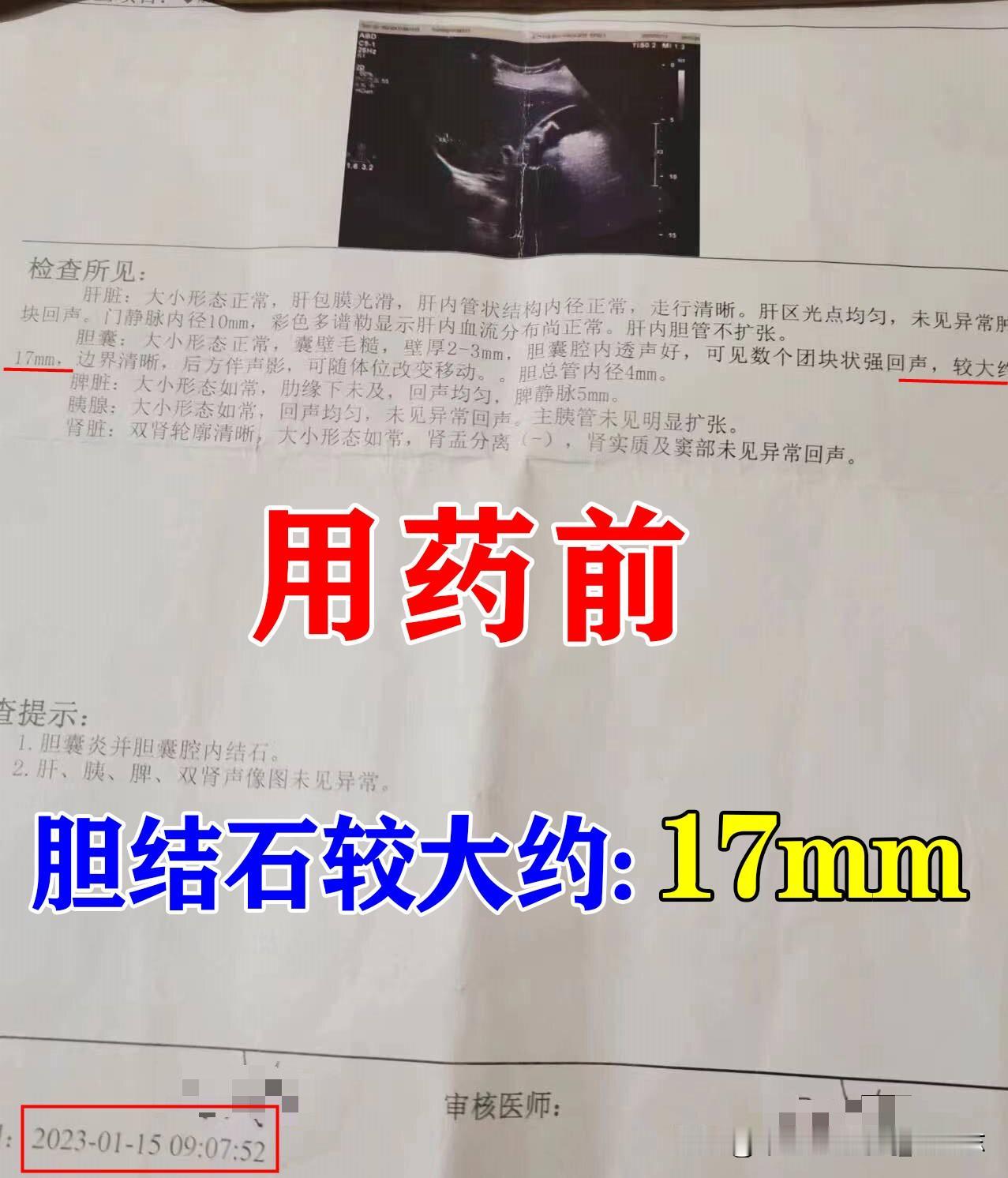 王女士因为晚上睡觉后背胀痛，白天两肋胀痛，去做了个检查，检查结果显示患者胆囊壁毛