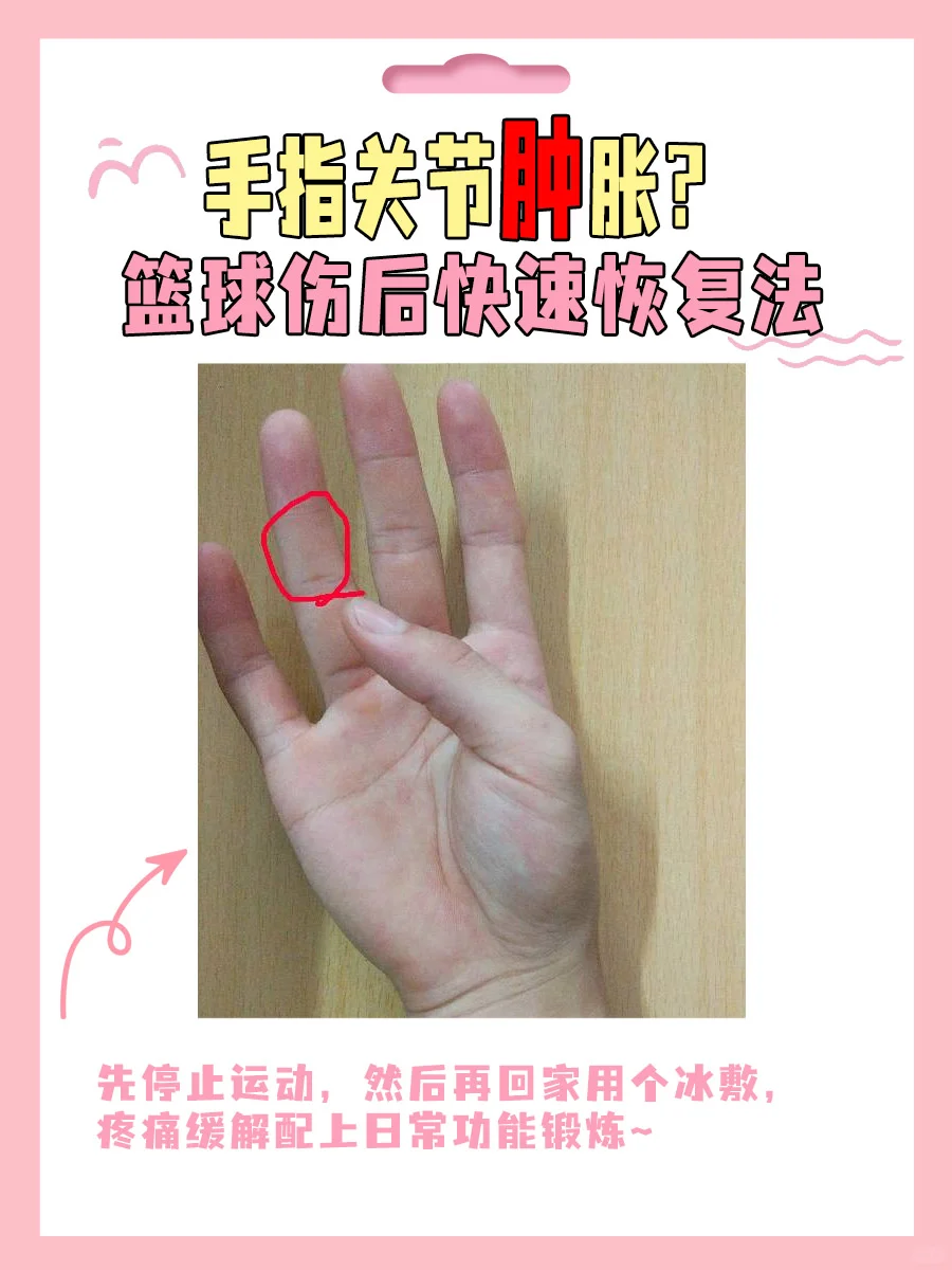 打篮球手指关节肿了怎么快速恢复