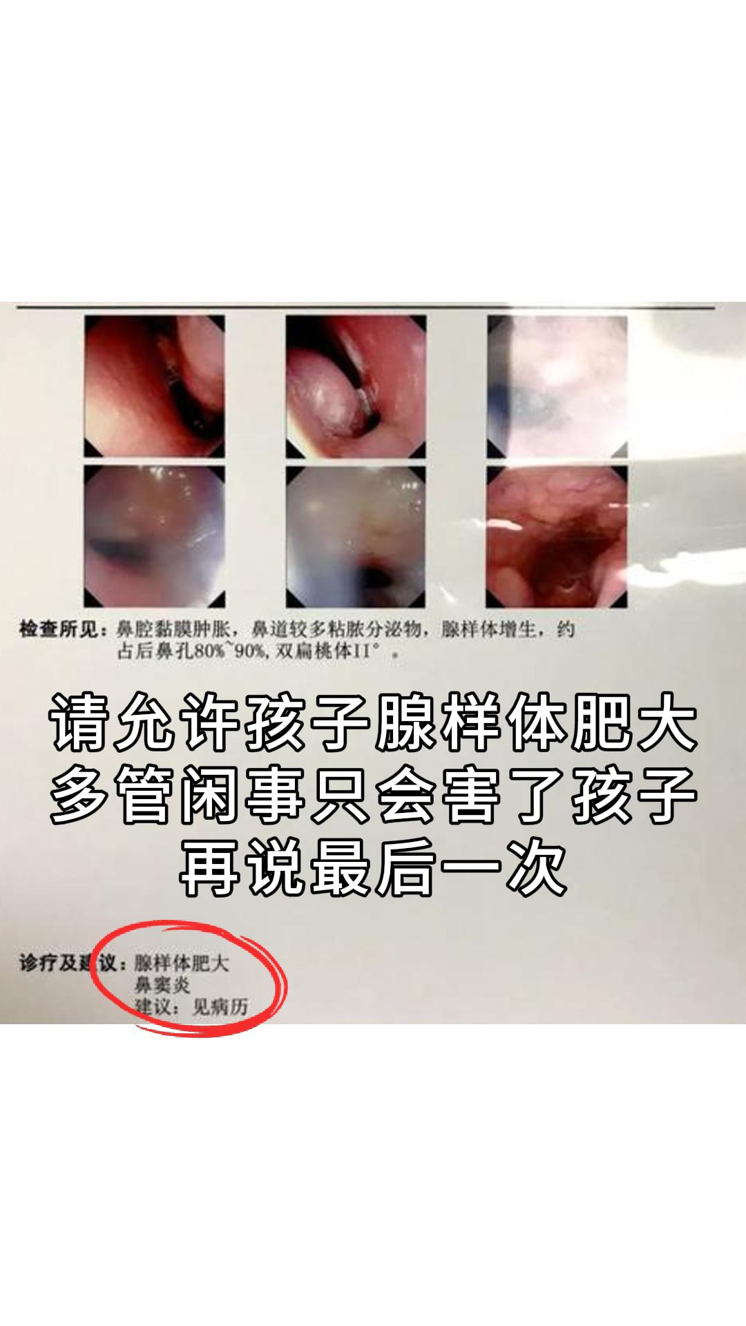 再说一次，请允许孩子腺样体肥大！你的多管闲事只会害了孩子。 - 从医4...