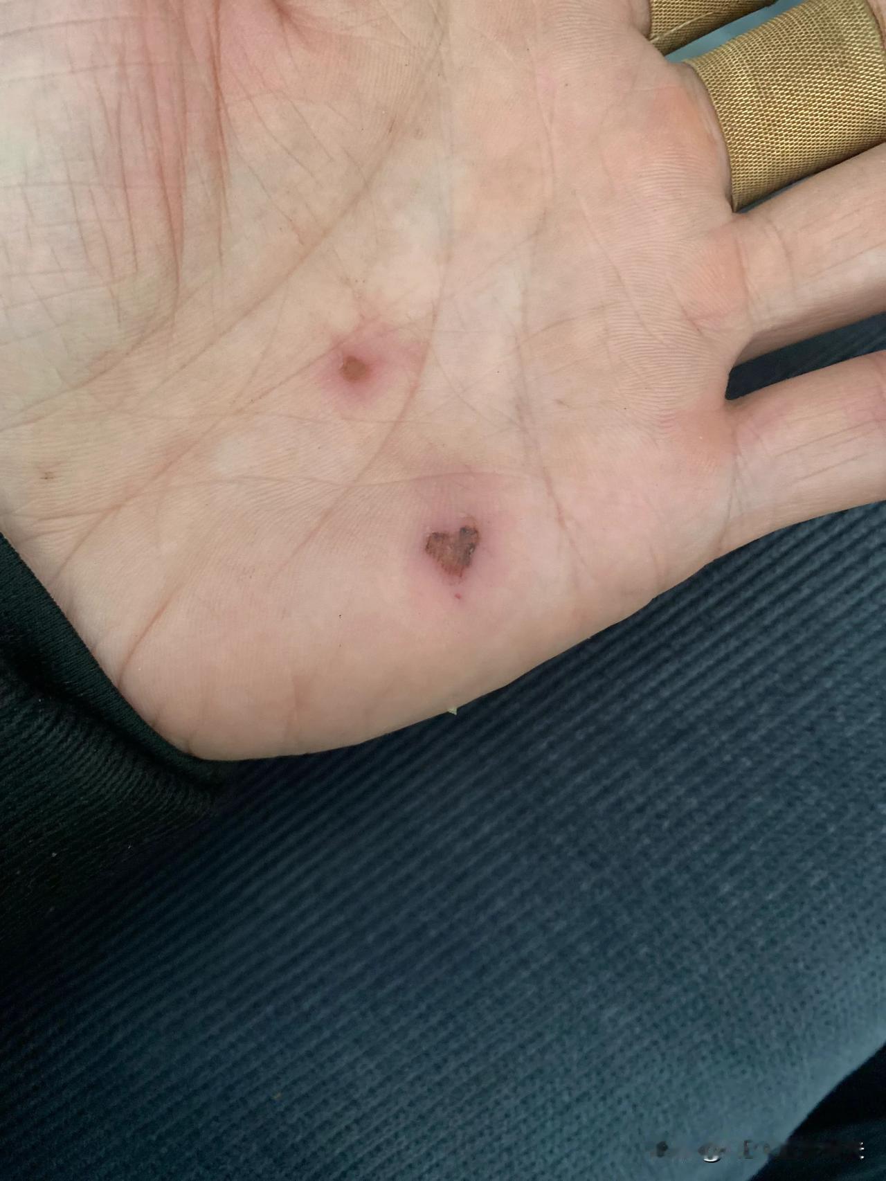 你瞅瞅，受个伤还是心形的，厉害吧