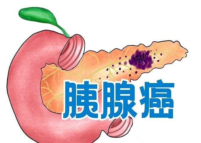 都说它是“癌中之王”。
我琢磨了很久，这个“王”到底霸道在哪儿。后来才想明白，它