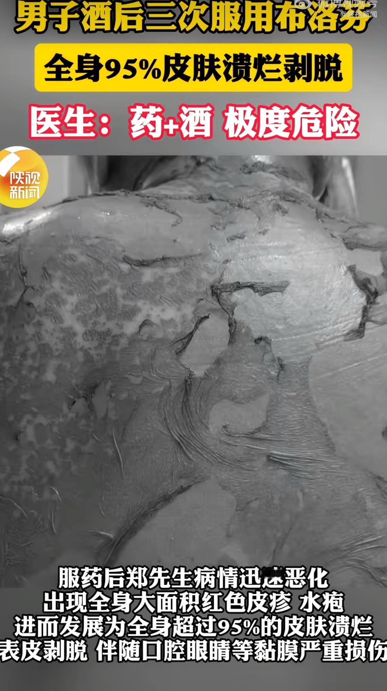 男子酒后3次布洛芬全身95%溃烂醒酒前不能乱吃药，真心不建议喝酒，高度致癌物。 