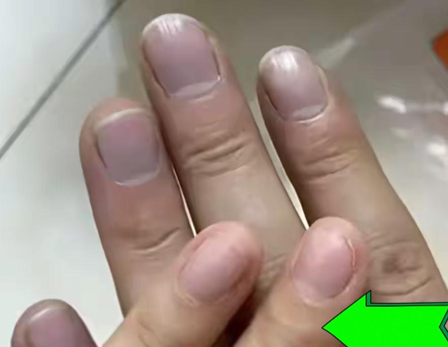 丈夫指甲发紫骂妻子瞎操心，3天后心梗送医：十指连心真不是玩笑
 
“纯粹是吃饱了