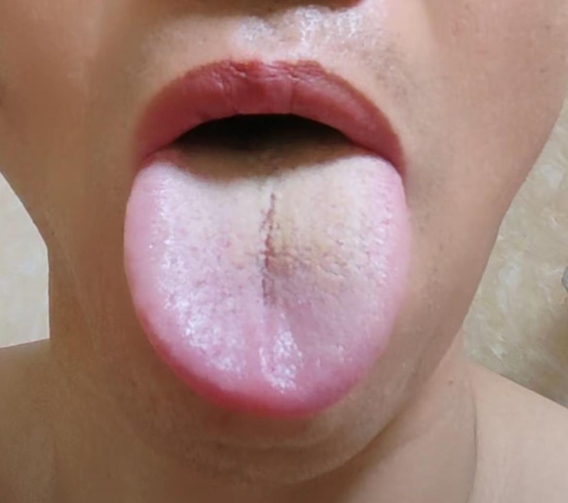 男人不敢肝郁化火，这可比肾虚还恐怖啊[泣不成声][泣不成声]
像病友这种舌象，已