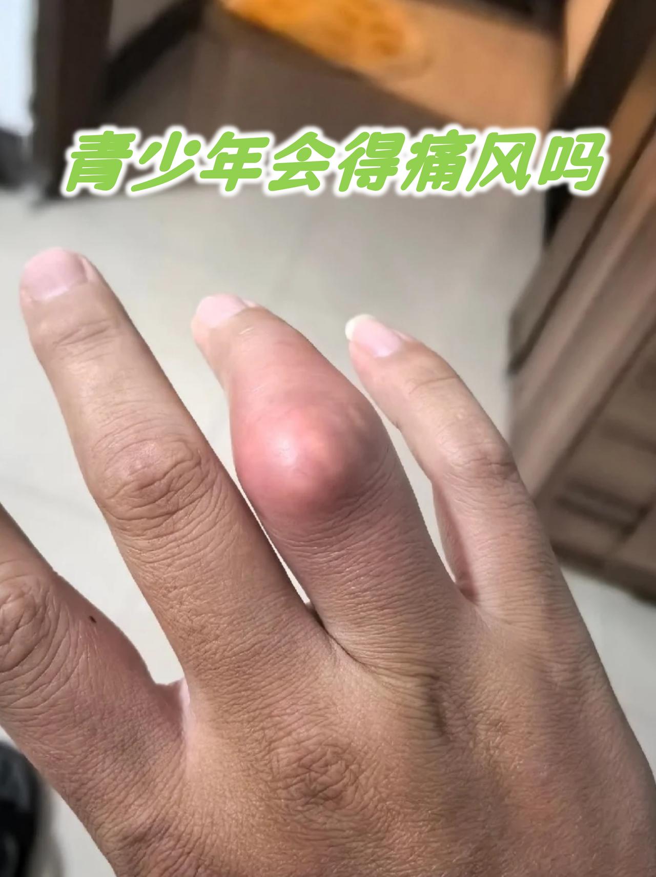 8岁孩童确诊痛风，儿童痛风低龄化趋势引担忧。
近日，一名8岁儿童被确诊为痛风的案