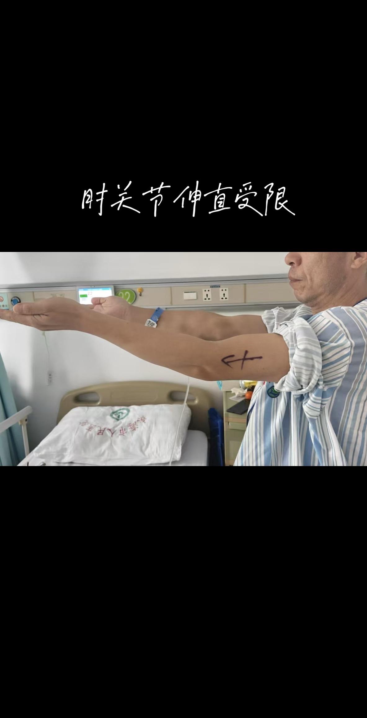 肘关节伸直受限 什么问题呢。案例分享