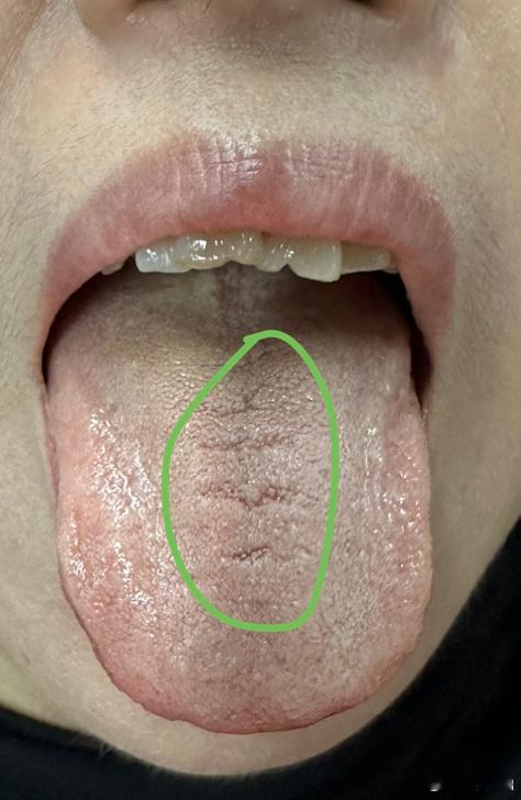 女同学面部和腹部肤色暗黑，唇周色深，瘀血象，腹诊胃区硬，为大瘀血结。西医诊断为萎