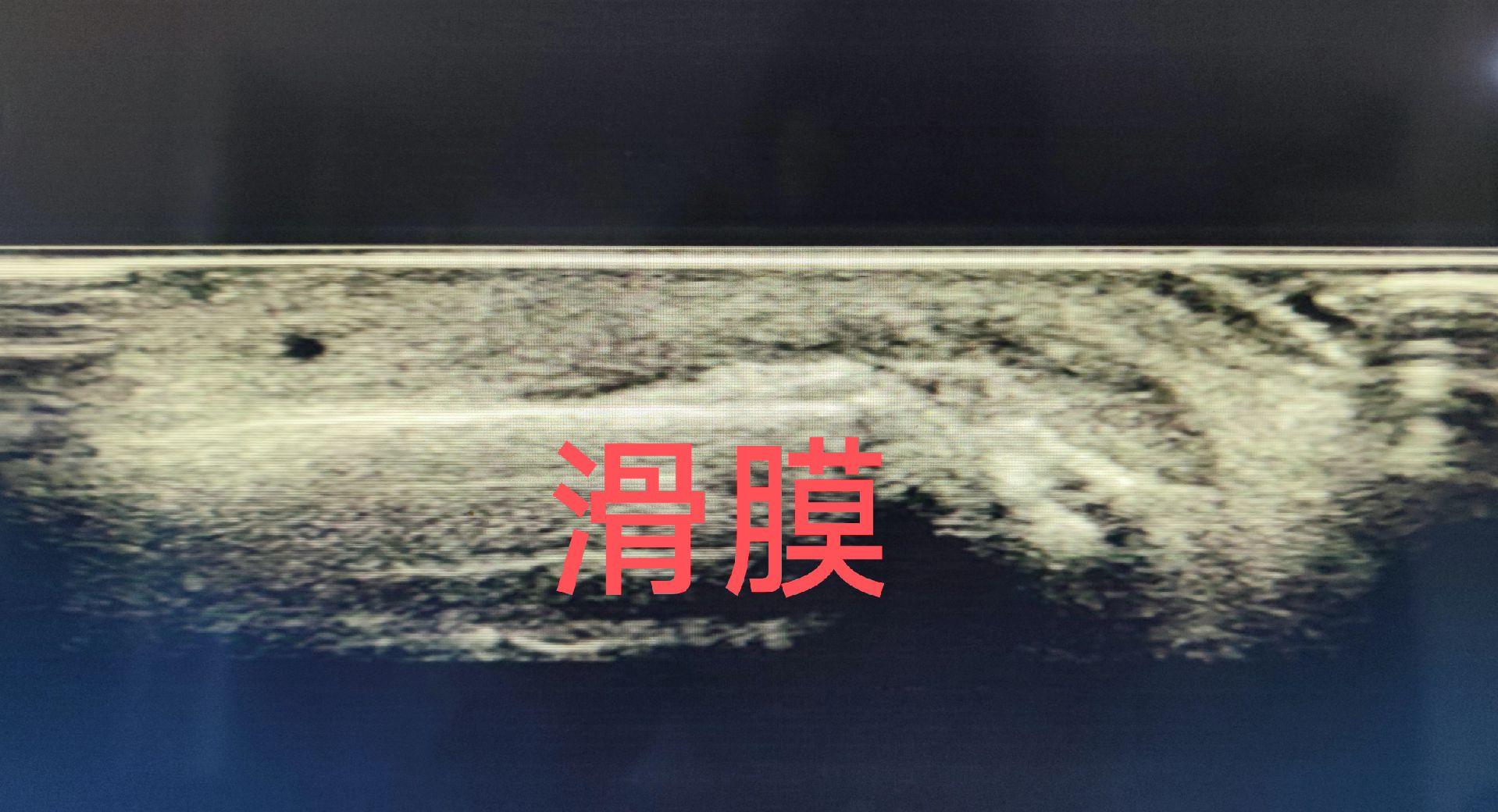 滑膜超声。滑膜增厚，血流增多，滑膜囊积液 一般不做病因诊断