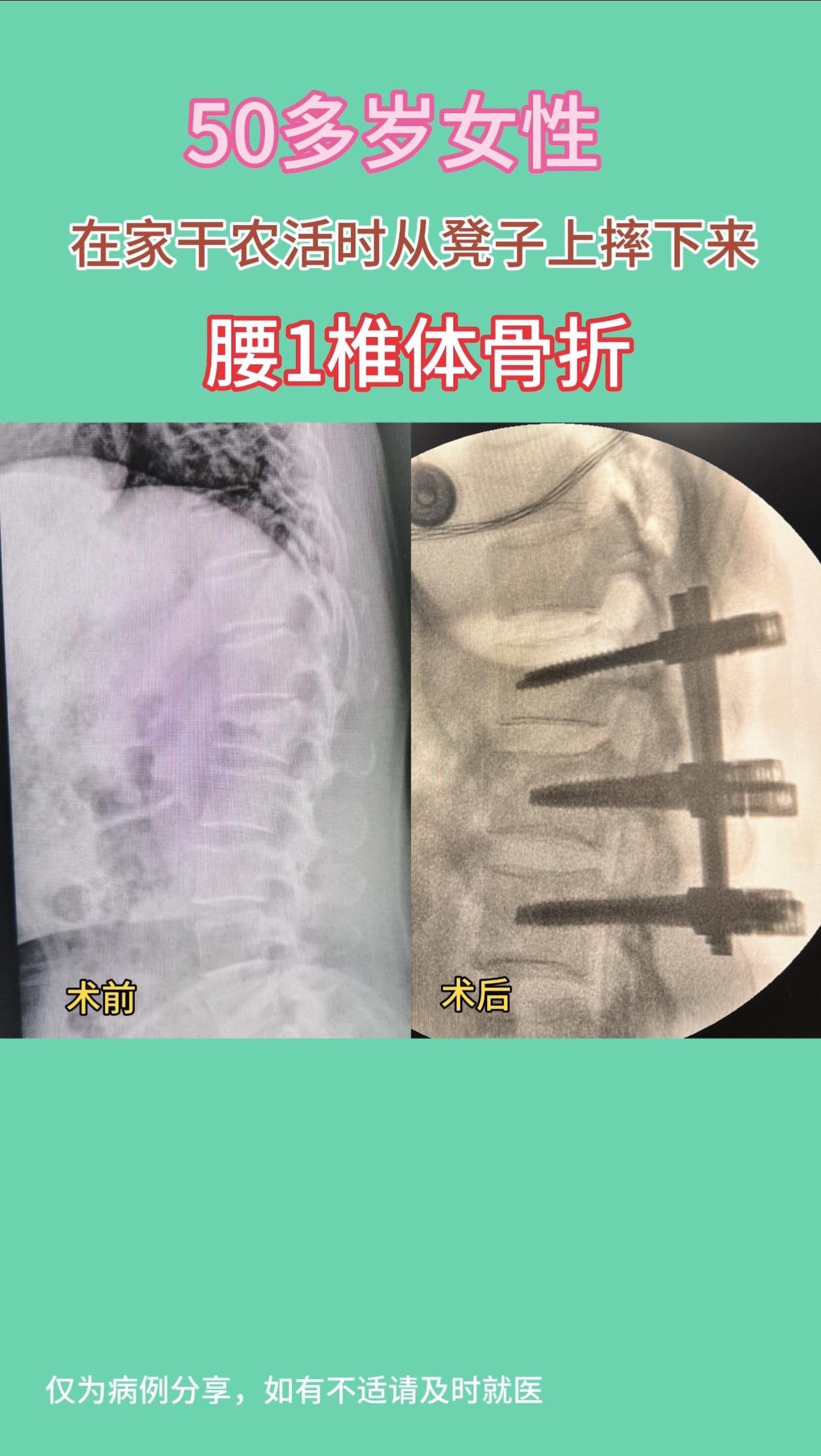 50多岁女性，在家干农活时从凳子上摔下，腰1椎体骨折，手术后复位理想...
