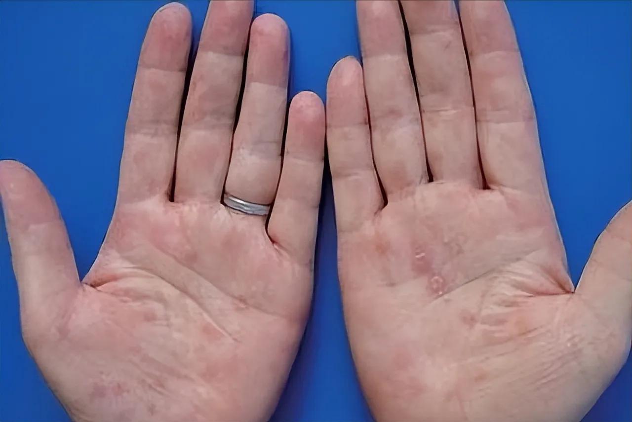 医生分析500名梅毒患者，总结出易感染者的五大特点。一是皮肤黏膜出现无痛硬疹、对