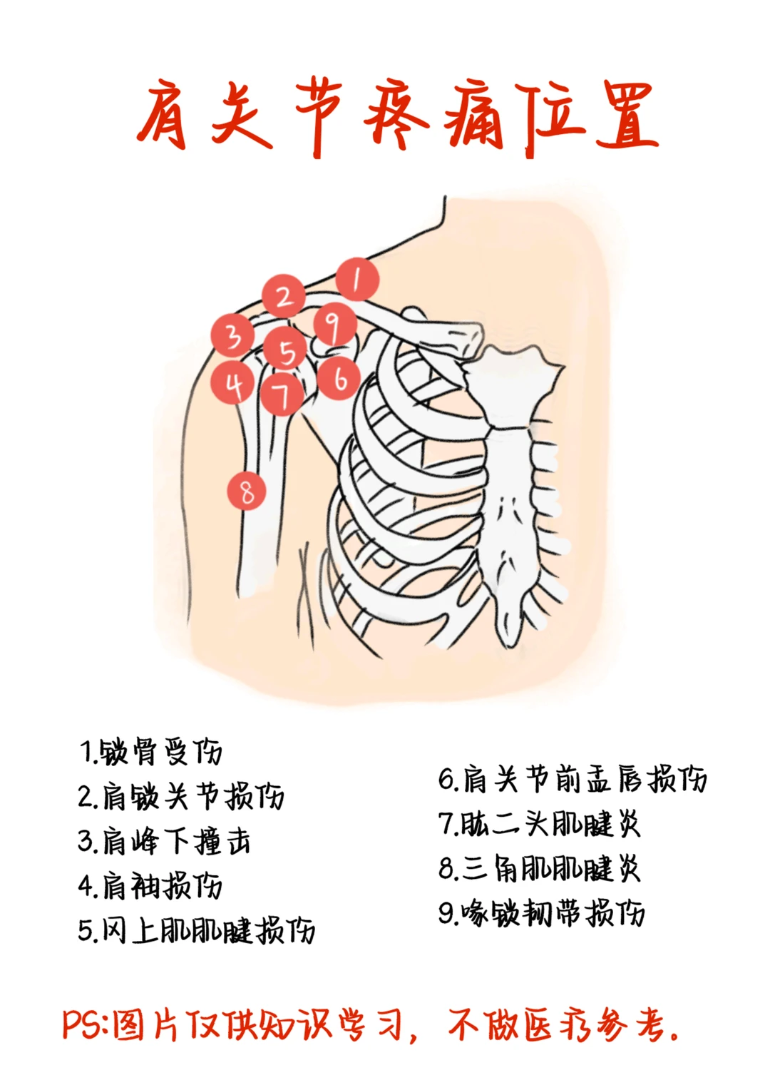 医学生笔记——肩关节疼痛位置