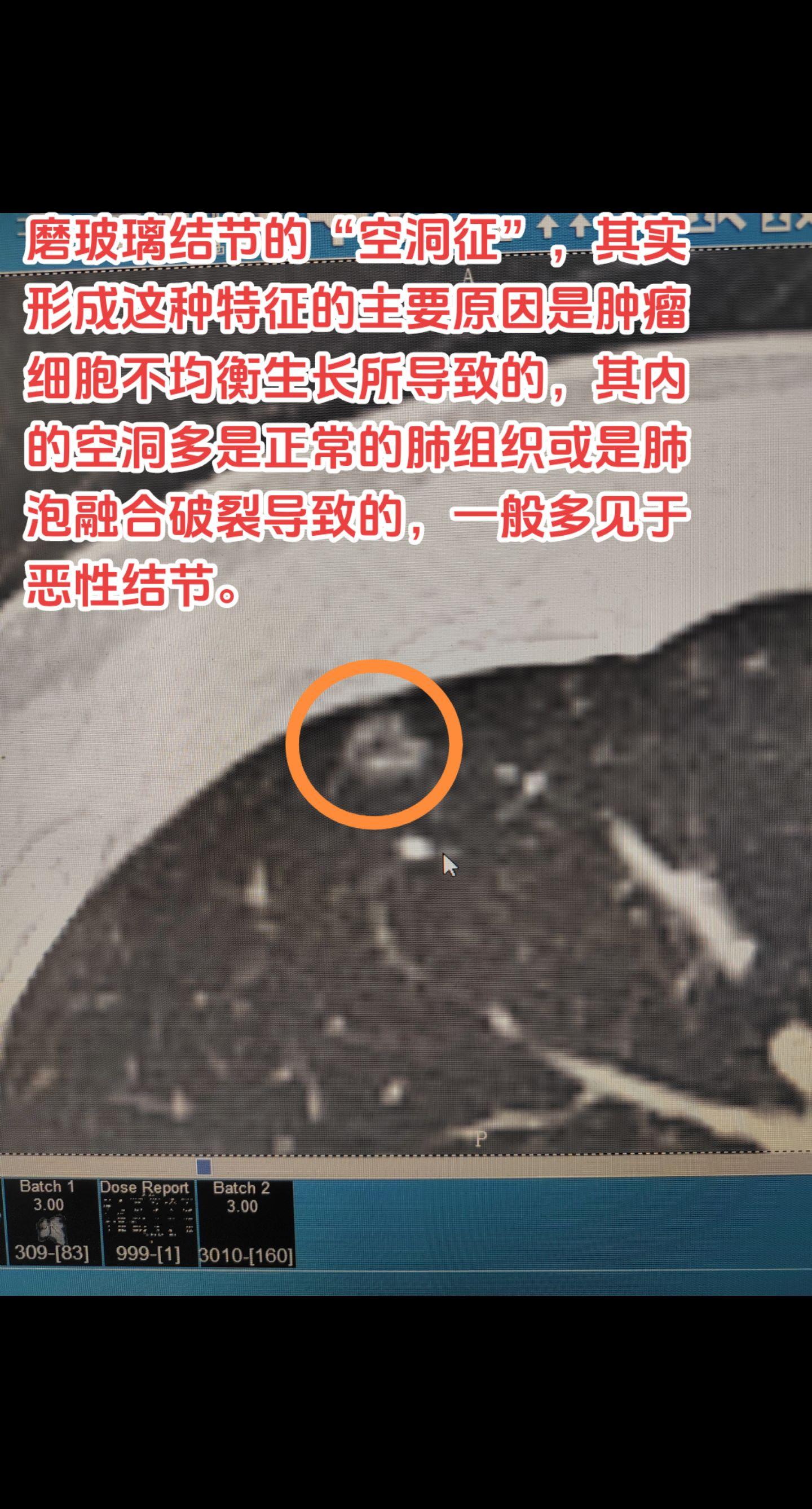 肺结节的空泡征的原因是什么？磨玻璃结节的“空泡征”，其实形成这种特征的主要原因是肿瘤细胞不均衡生长所导致的，其内的空泡多是正常的肺组织或是肺泡融合破裂导致的，一般多见于恶性结节。有空泡的结节一般在结节周围密度较高，如果高于-500常考虑微浸润及以上的恶性肿瘤。