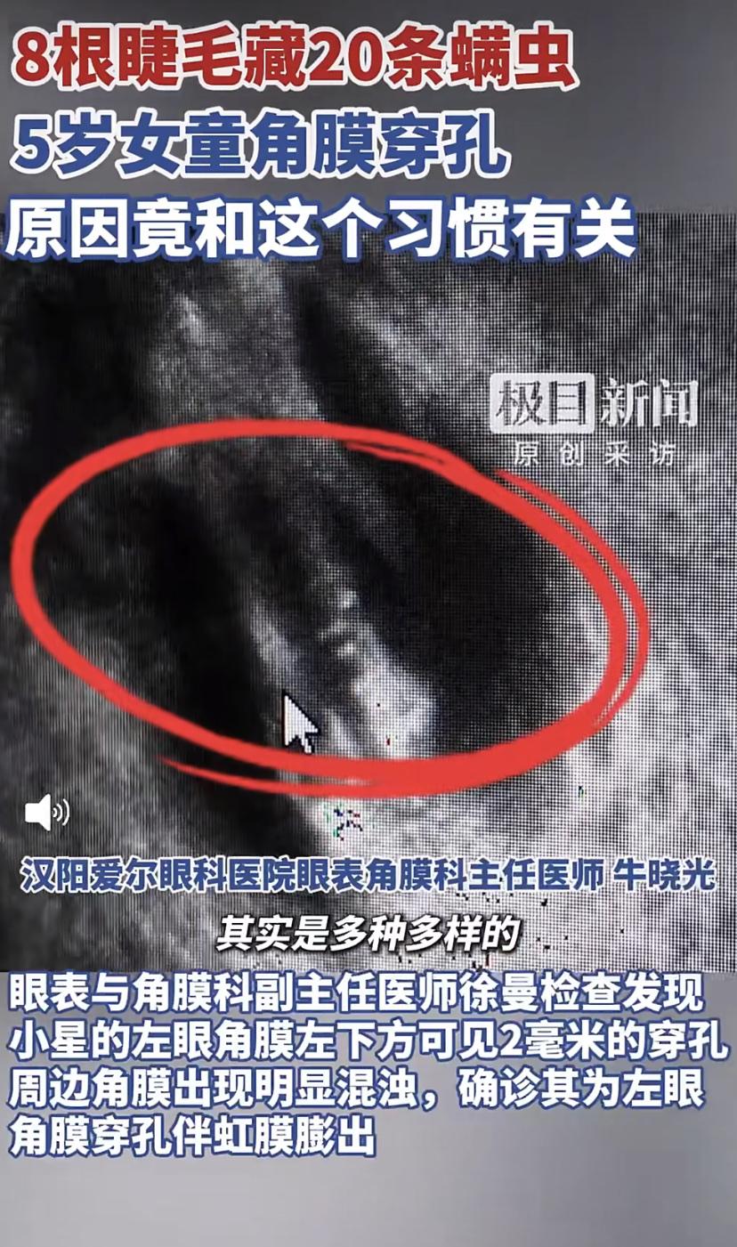 5岁女童眼睛痒没在意，结果角膜穿孔!医生在她睫毛里揪出20条螨虫
湖北荆门5岁女