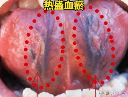 身体瘀血的四种类型，快来对照看看
1.热盛血瘀
表现：上火、牙龈肿痛、鼻腔干燥、