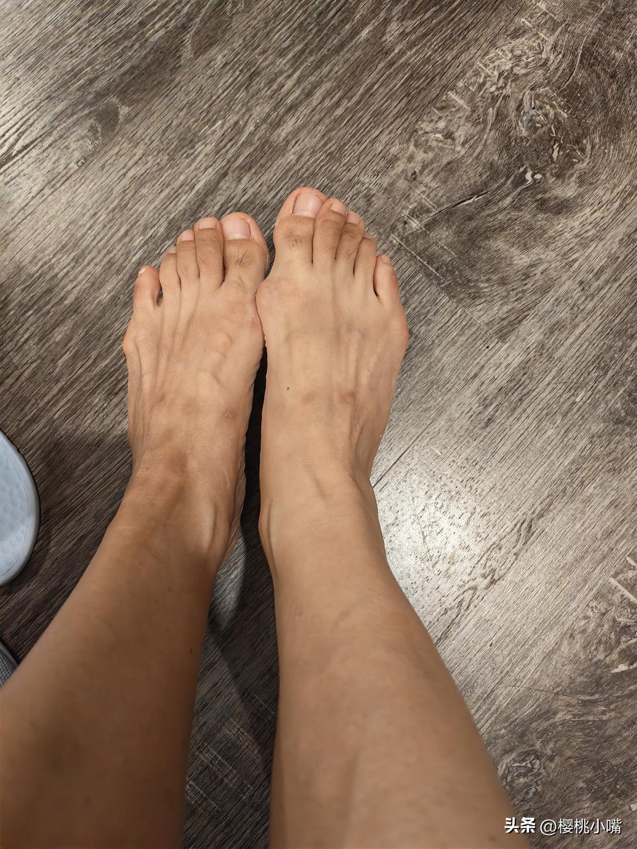 我的拇外翻越来越厉害了，虽然不疼但是弯的严重，两个戒指已经叠起来了。
我从饼西西