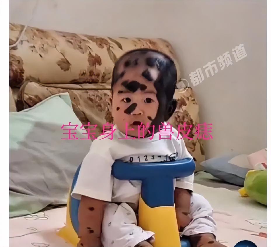 产检绿灯却遇“兽皮痣”，90%皮肤被覆盖的宝宝，盼一束生命之光
 
“一路产检都