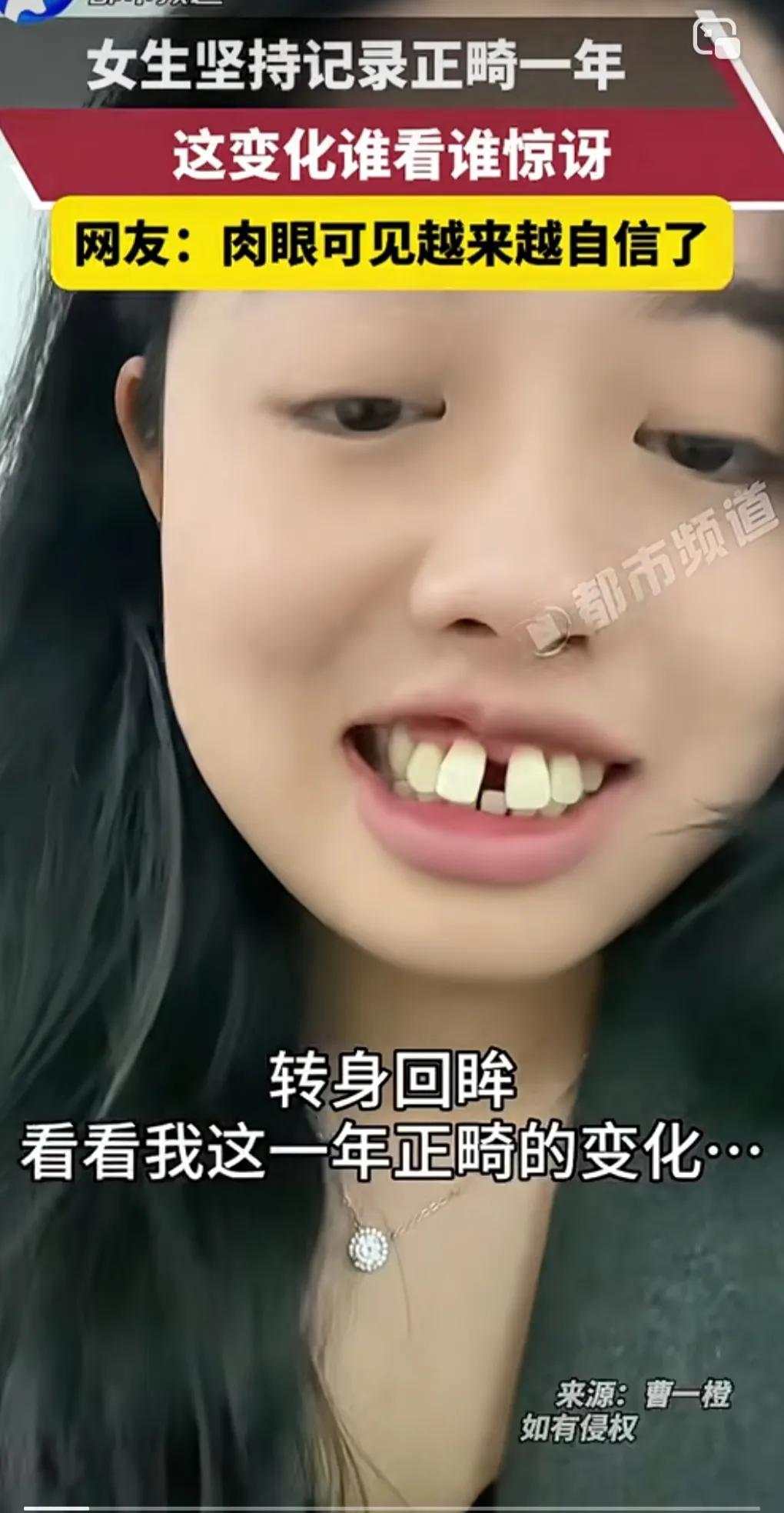 重庆一女子龅牙，门牙缝隙还很宽，非常难看。
牙齿矫正后一年，牙缝隙没了，整齐了很