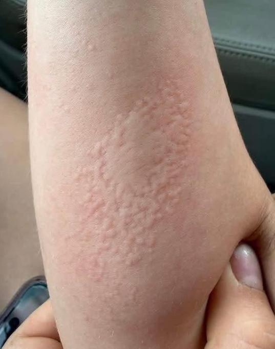 一名年轻女孩和认识很久的外国男网友线下奔现，共处一晚后，身体突然不对劲。第二天一