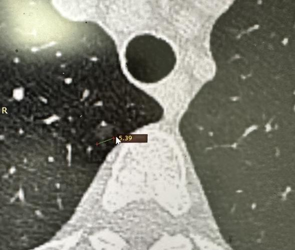 经常有人说“平均8个人里就有1个有肺结节，而且还是可疑性质的”。这话一出来，很多