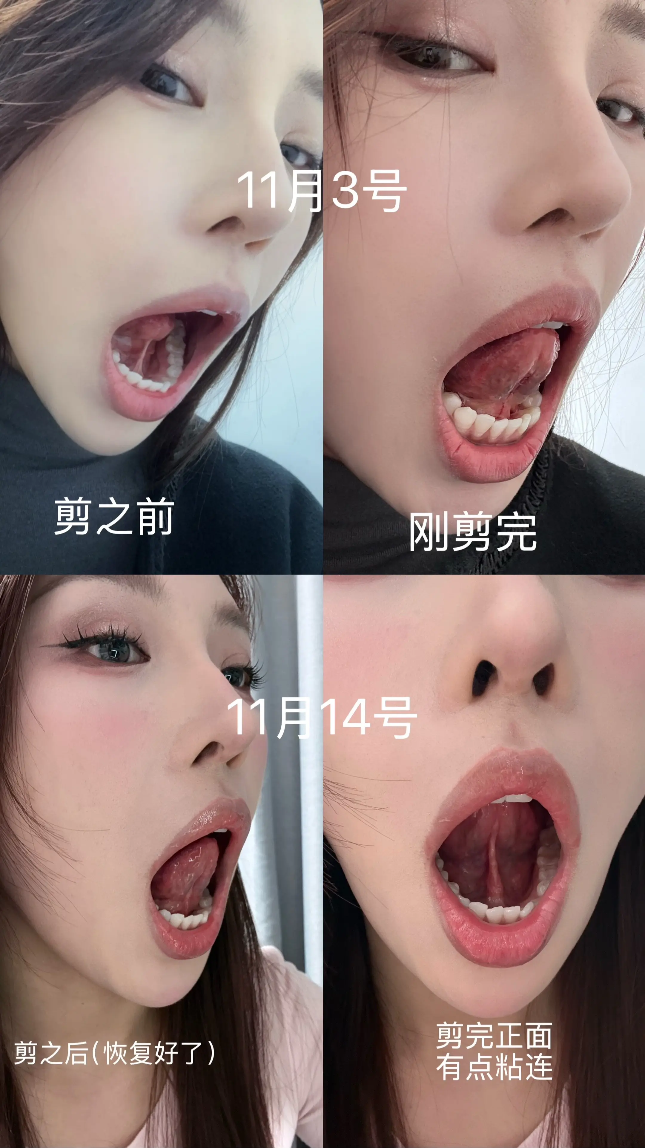 本来小时候就应该剪舌系带的👅，拖到现在。