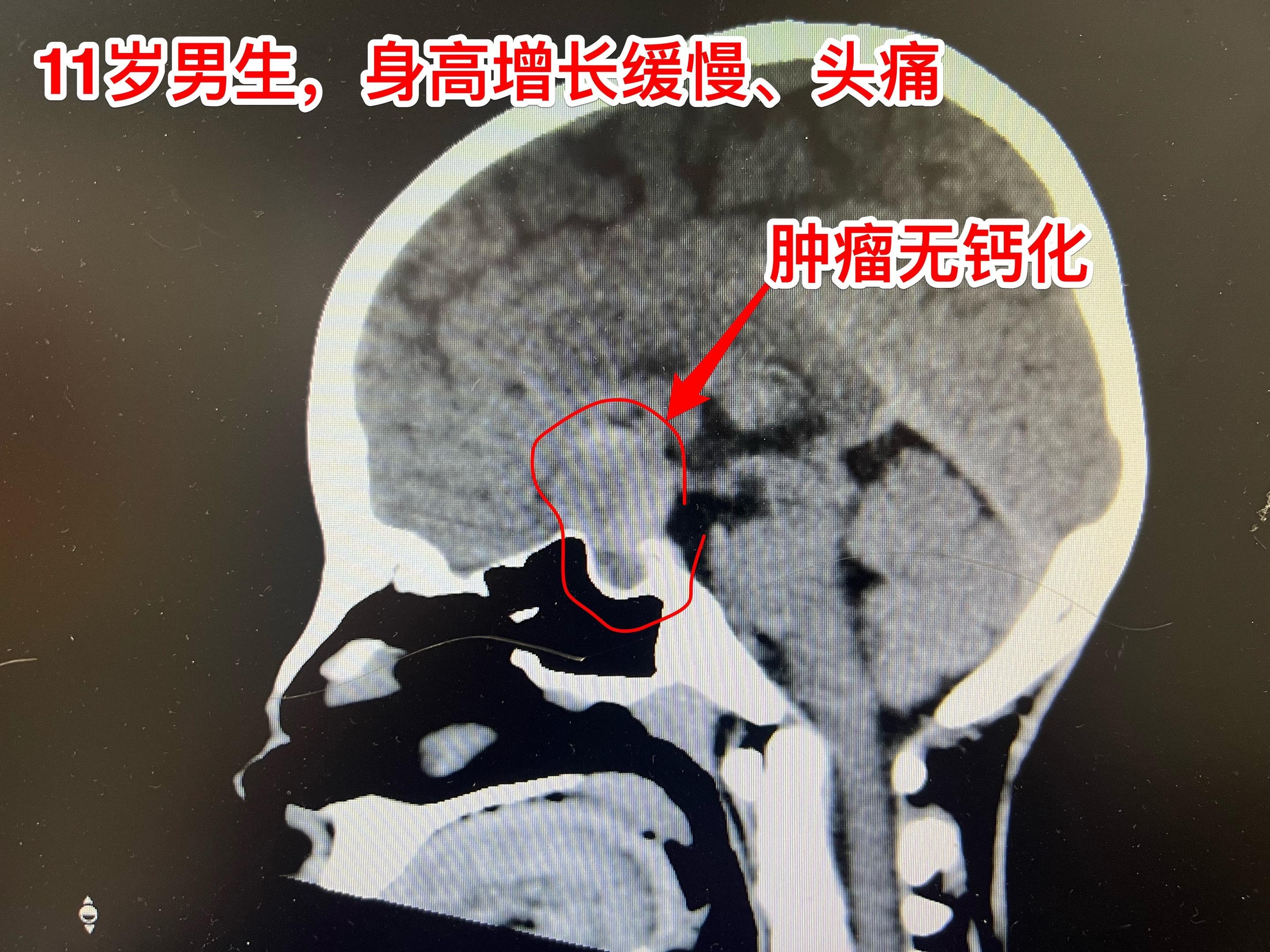 11岁男孩子患乳头型颅咽管瘤。11岁男孩子患乳头型颅咽管瘤，属于罕见病...