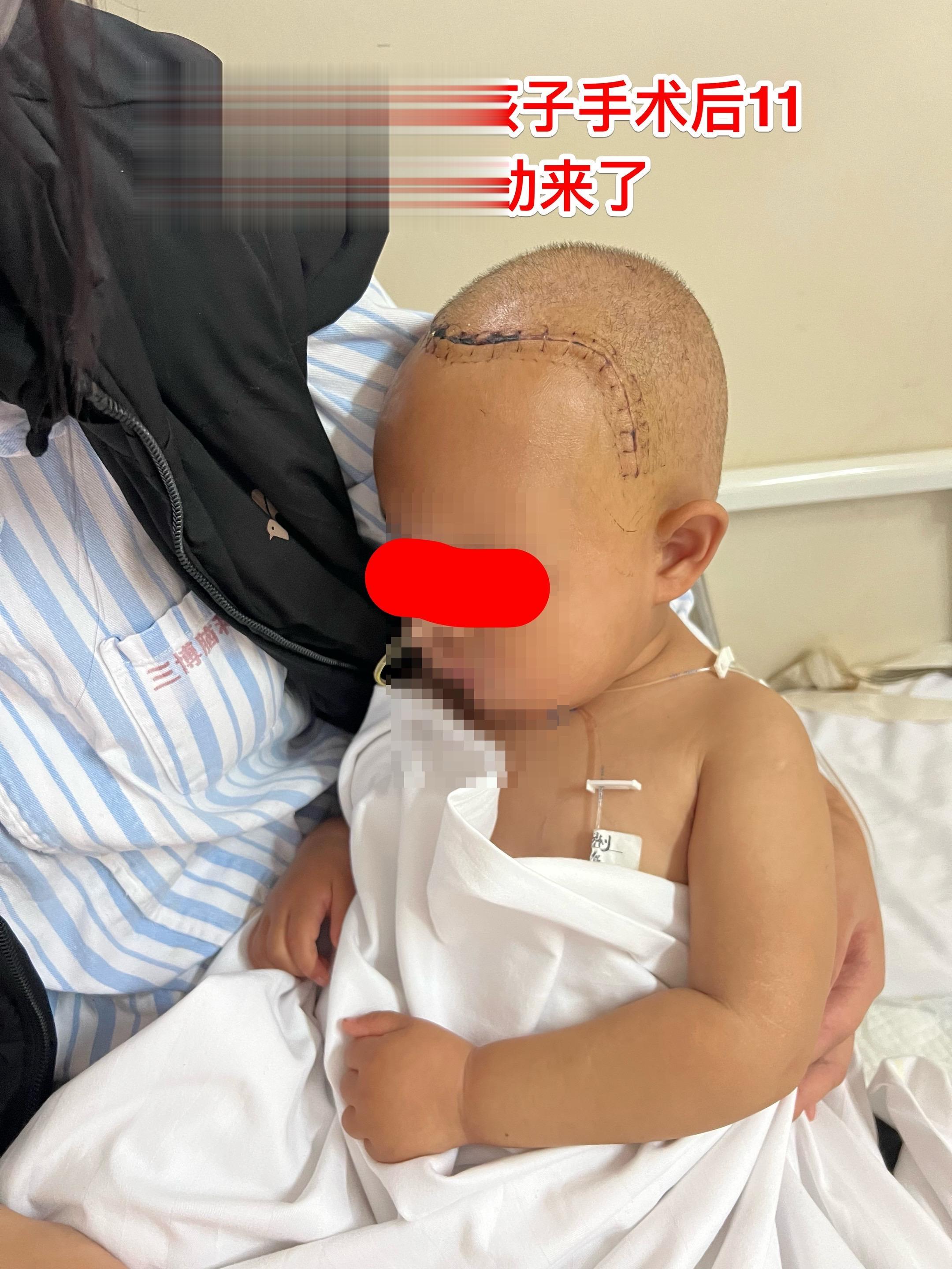 一岁十个月小孩子颅咽管瘤手术后11天。身体终于缓过来了！       ...