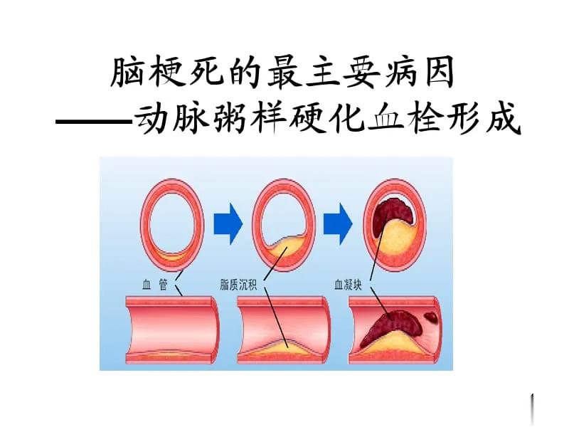 脑梗是“作”出来的，4个坏习惯，脑梗随时爆发所谓疾病源于生活，的确存在一定道理，