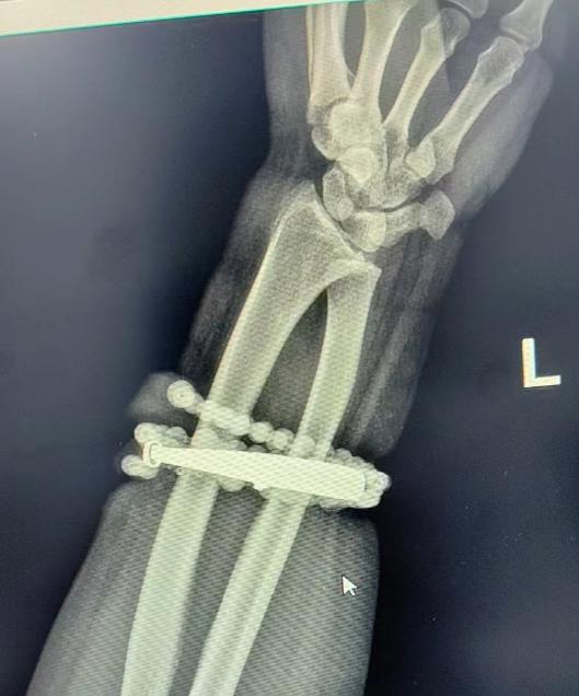 女子手镯10年没摘竟“长”进肉里！医生：再晚点就保不住了

戴了十年没摘的手镯、