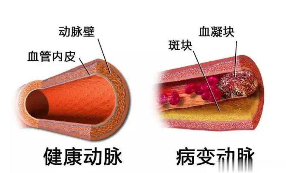 血脂高血管会长斑块，这几类人更容易高血脂​​1.有血脂高家族史的，尤其父母在50