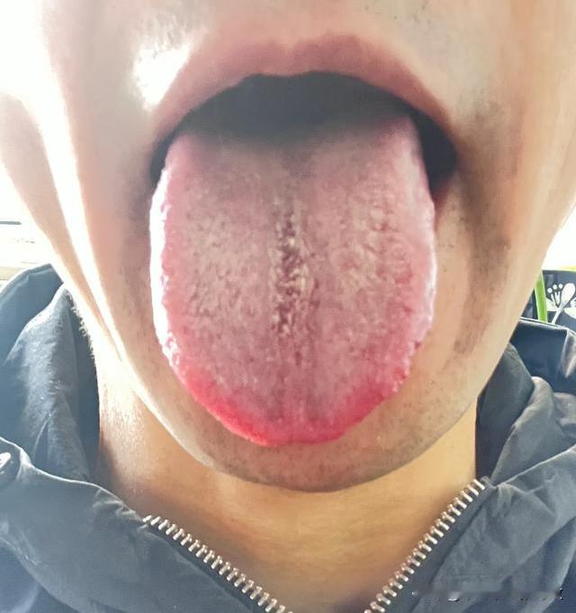 舌尖发红，舌中裂纹，这舌像那可真是遭老罪了[流泪][流泪][流泪]
粉丝反馈：吃