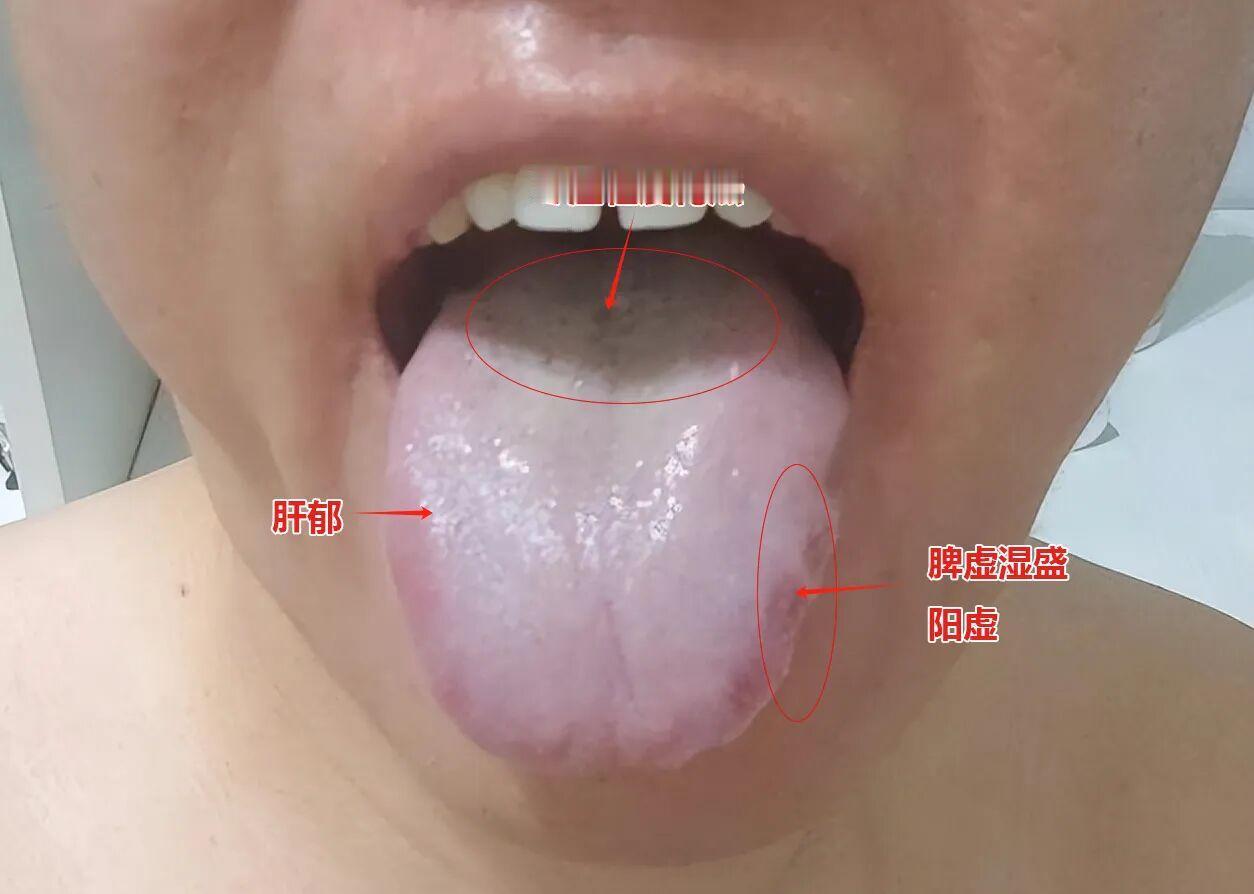 揭示脾虚湿盛患者治疗难题，温补肾阳才是关键
这位患者，尽管他的舌象表现出脾虚的特
