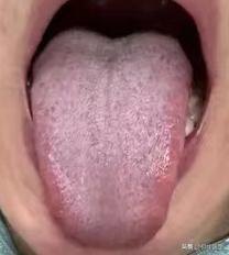 这样的舌象你不疏通，再补个十年也没用

舌头已经淤的泛紫了，还在这补，能有效果才