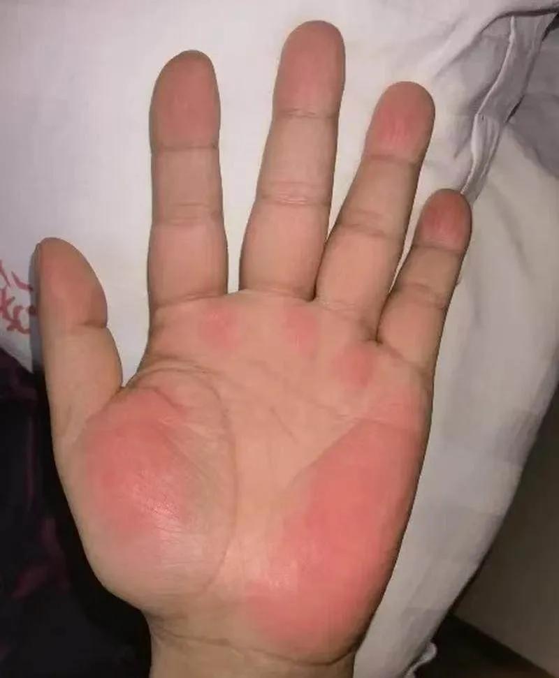 细节藏健康，别忽视身体预警
 网友的担忧并非多余，肝掌这类表现往往容易被当成普通