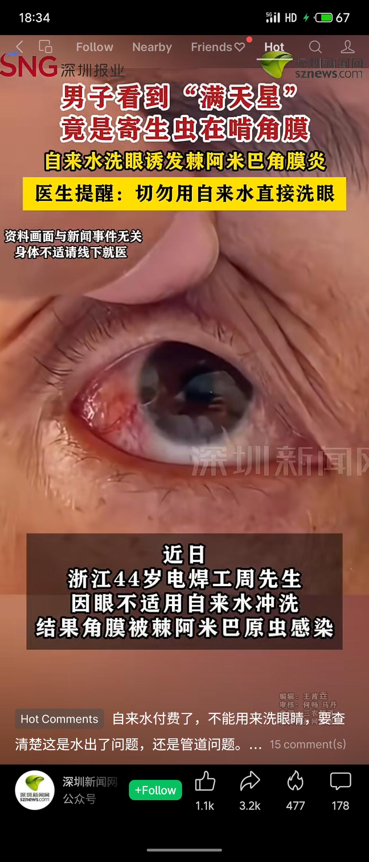 浙江44岁电焊工周先生因眼不适，用自来水冲洗，导致角膜被棘阿米巴原虫感染。检查发