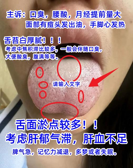 今日舌诊案例分析：寒湿血瘀，肝郁气滞，脾胃湿热[谢谢][谢谢][谢谢]