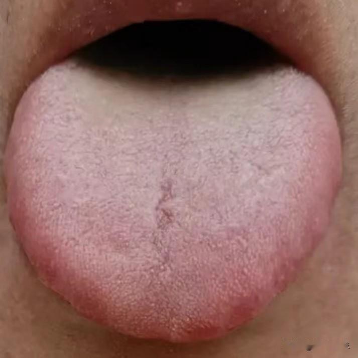 舌象分析：胃阴不足 食积生热 阴囊湿热
1、“舌苔干燥”——舌苔是胃阴是否充足的