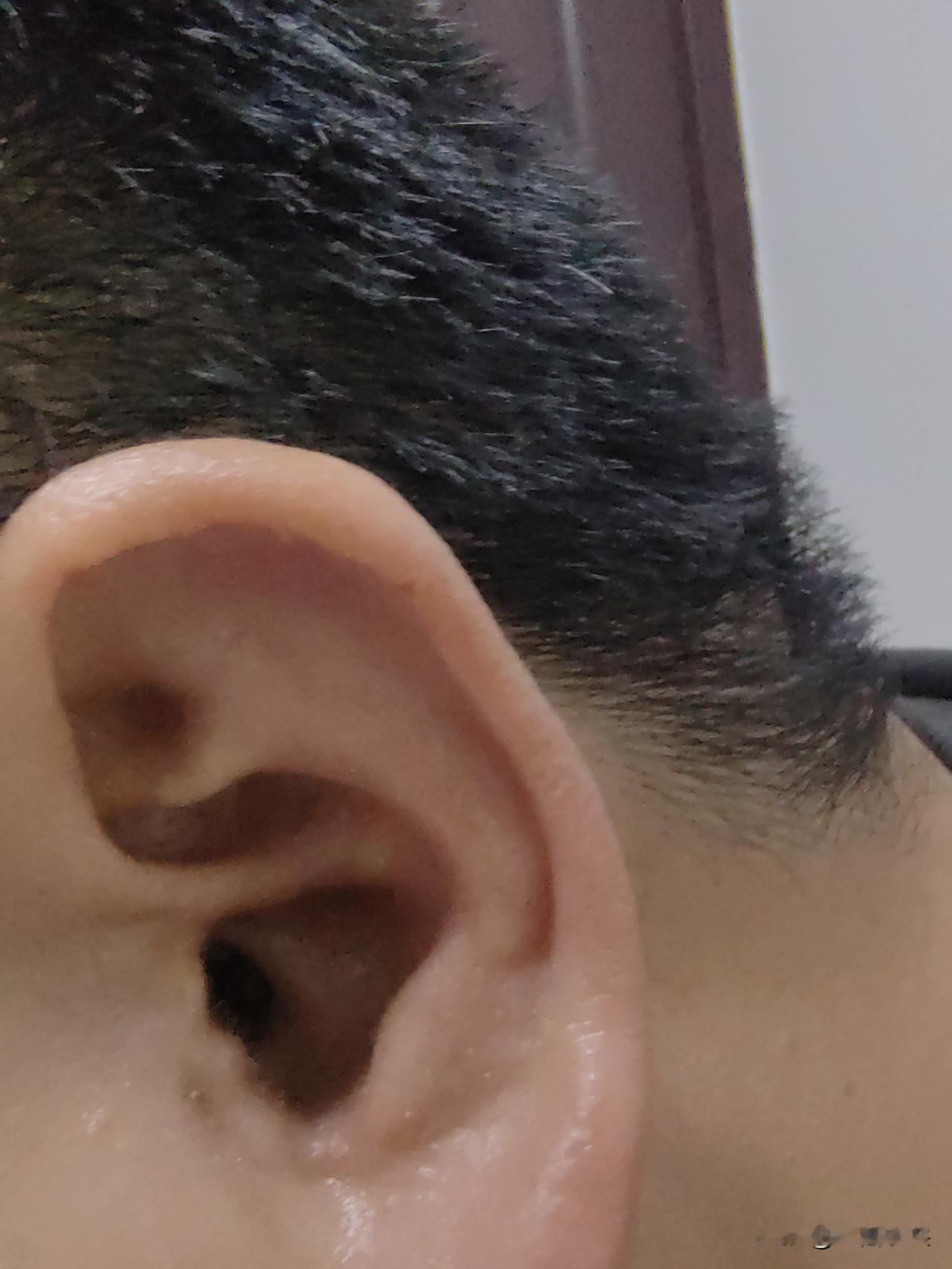 双喜临门，耳膜修补手术成功了！

现在可是双喜临门，2005年11月18日在上海