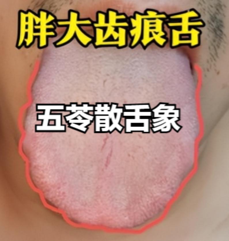 消齿痕舌最快的2条路：一条五苓散，另一条是温经汤！

第一条路：五苓散 —— 针