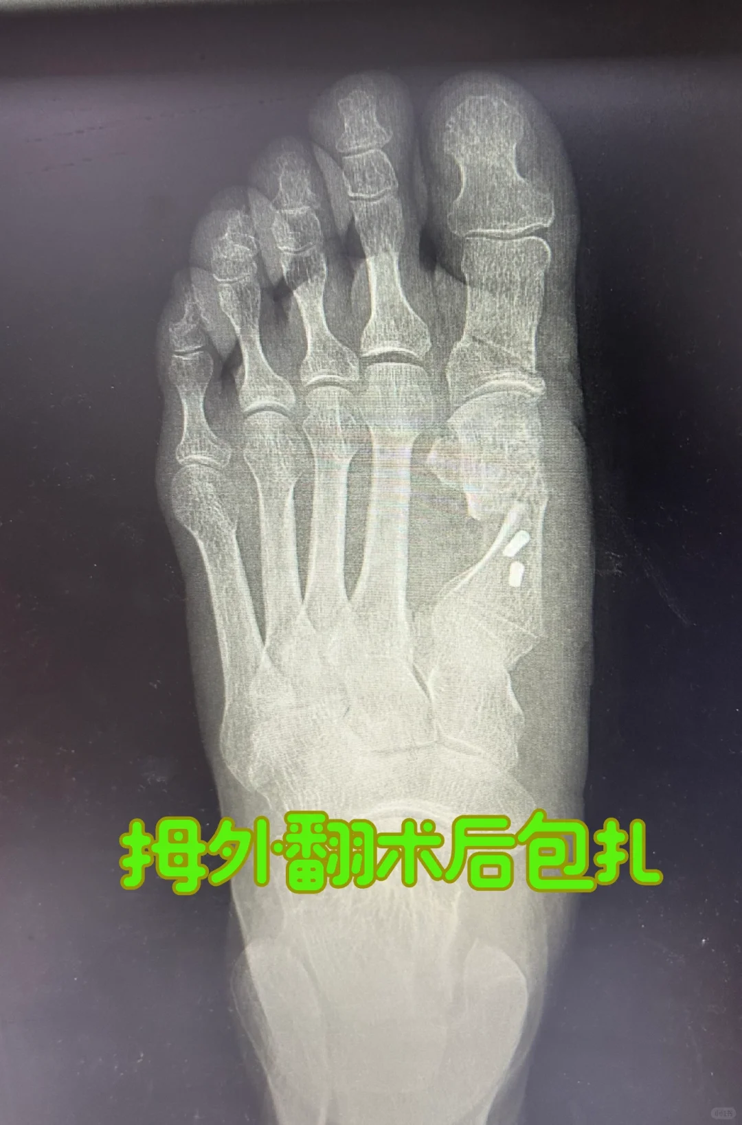 拇外翻术后如何包扎？