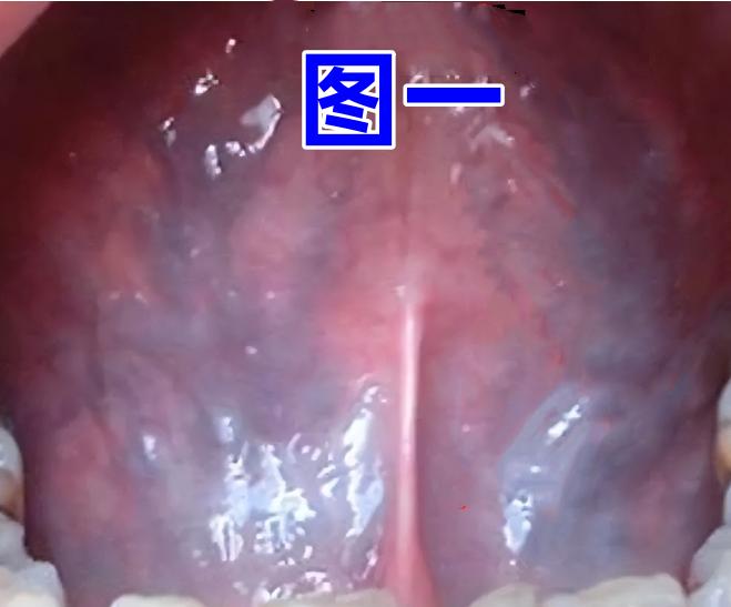 同样是血瘀，为什么用血府逐瘀丸没用？原因都在舌头上



一：图一——气滞血瘀
