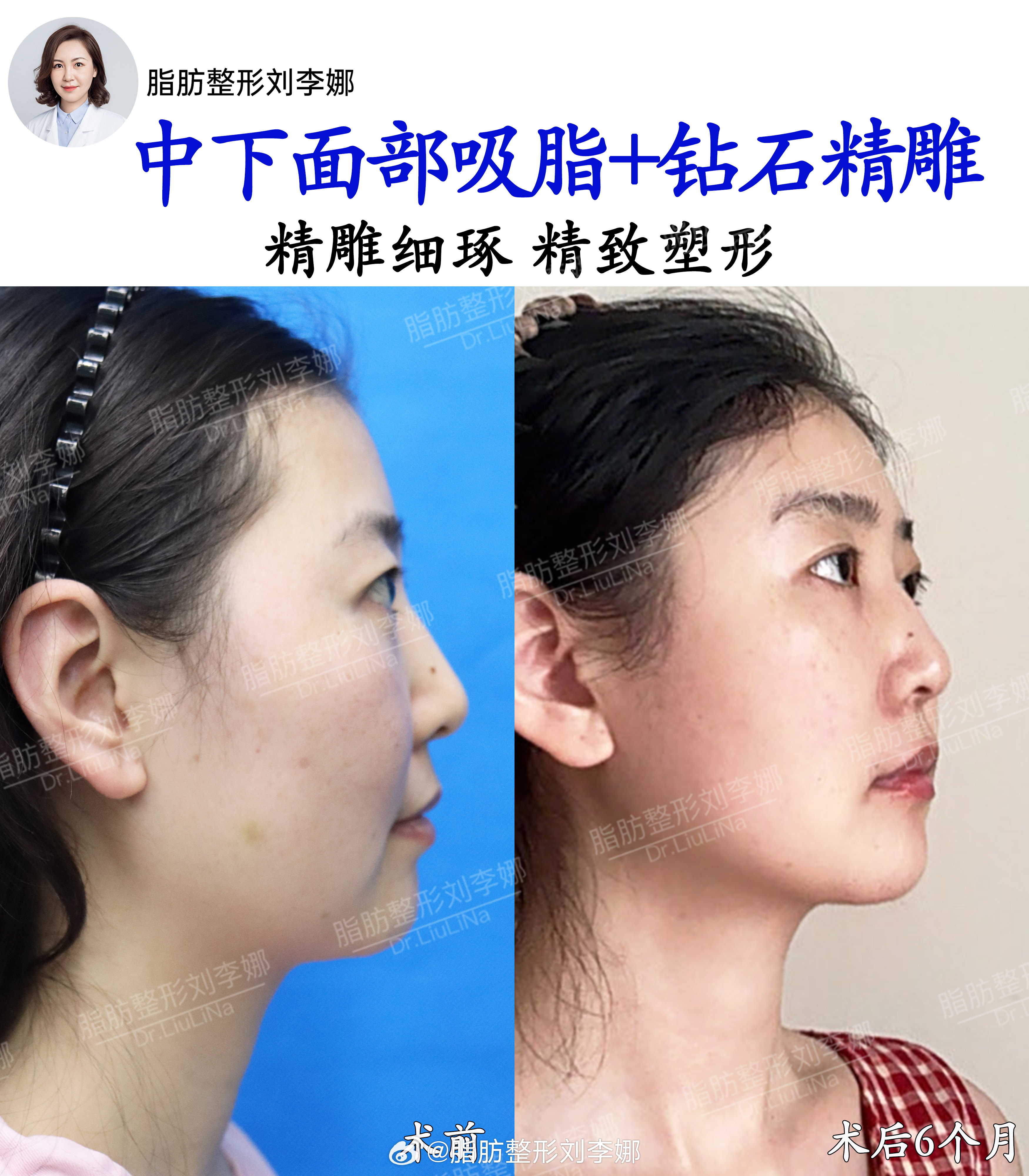 脂肪整形刘李娜 双下巴吸脂 面部吸脂 术前典型的苹果肌脂肪堆积，下垂导致轻微法令