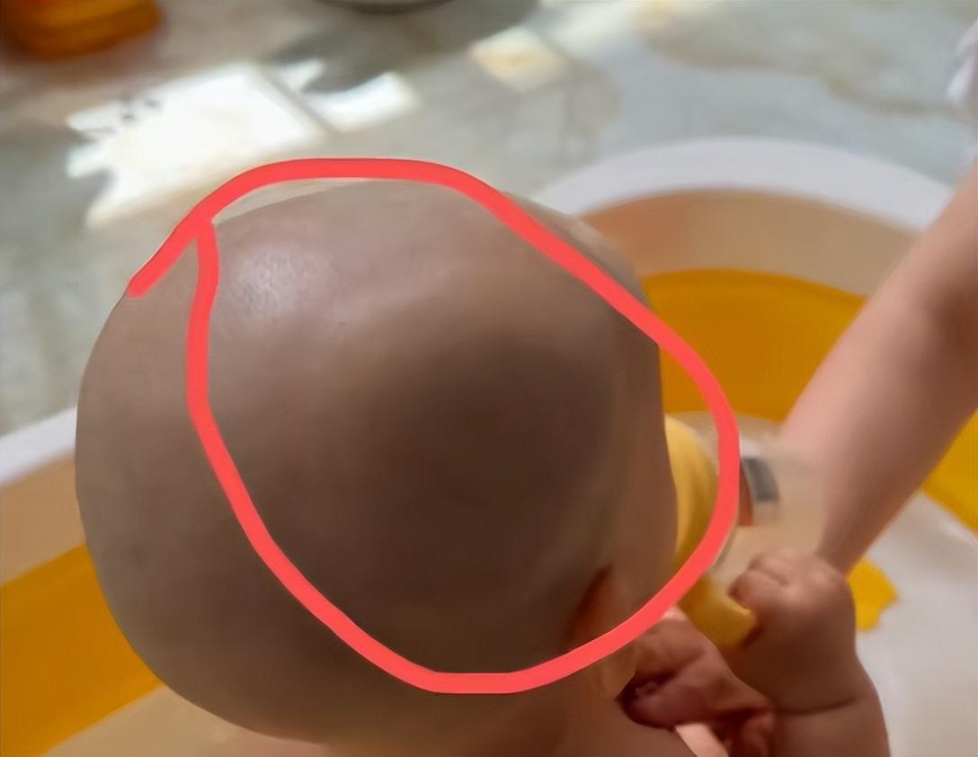 宝宝从餐椅跌落，家中老人不敢告知孩子父母，两天后孩子头部鼓起大包确诊头骨骨折，家