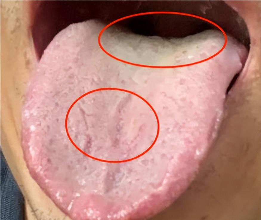 不要一功能下降就直接进补，忽略这一步，只会让你越补越虚
这一步指的就是清湿热，因