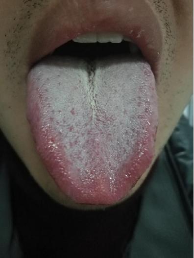 只要舌根处有白腻苔，那说明肾虚的比较严重！[炸弹]
 
说起这些男科问题，让很多